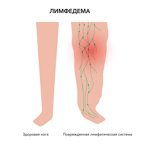 Лимфедема