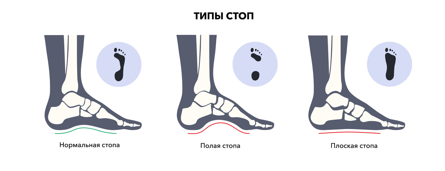 Типы стоп