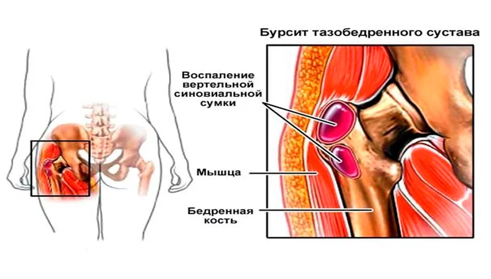 Тазобедренный бурсит