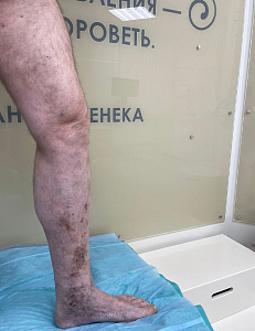 ЭВЛО и минифлебэктомия — после